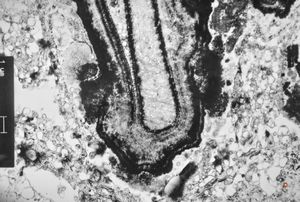 M,66y. | follicular cyst with hyaline Rushton bodies